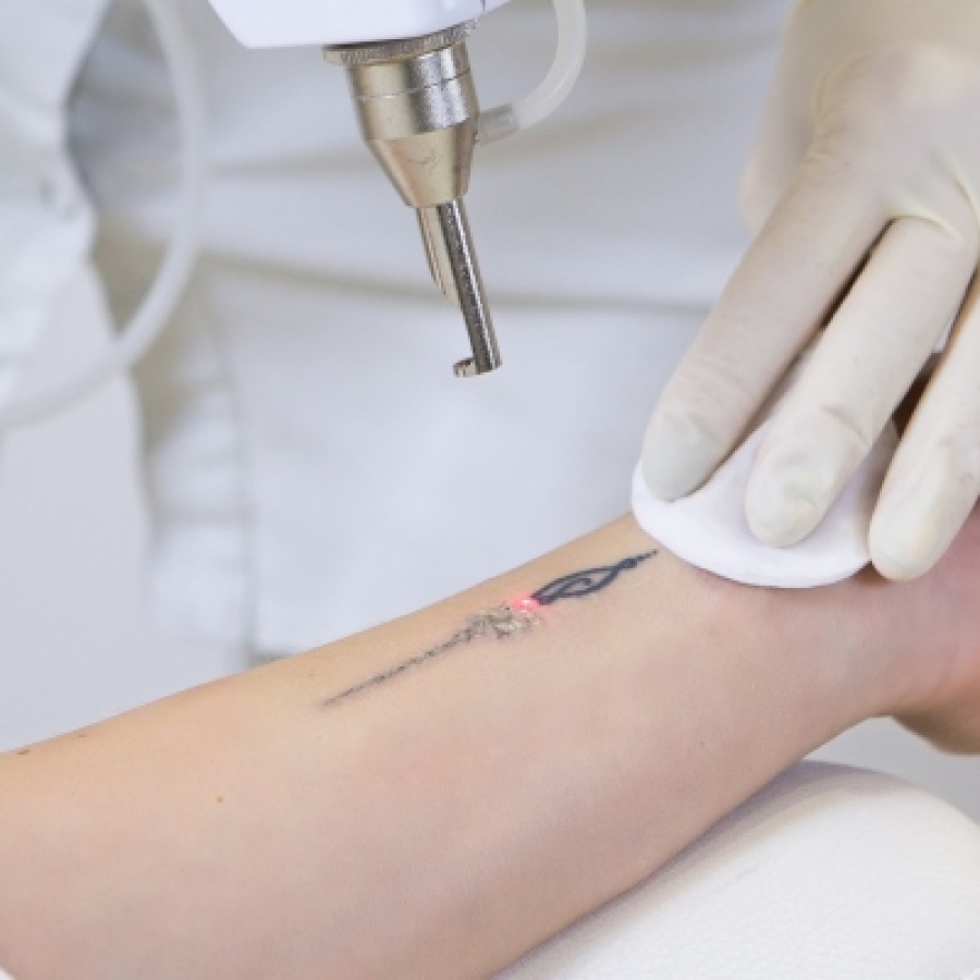 Laser for Tattoo & Hair Removal